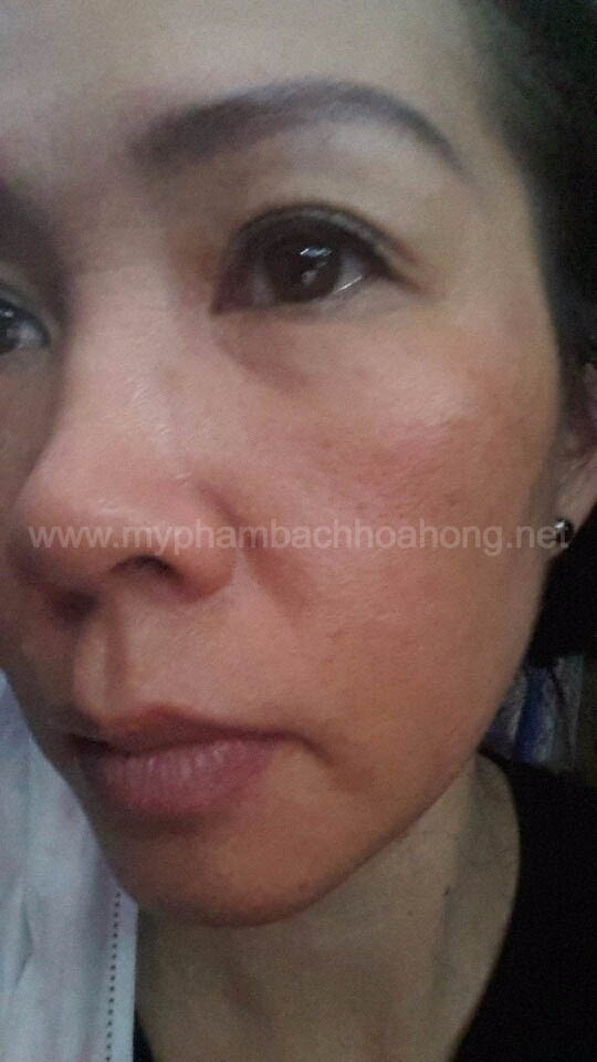 Bạch Hoa Hồng Trị Hêt Mụn Nám