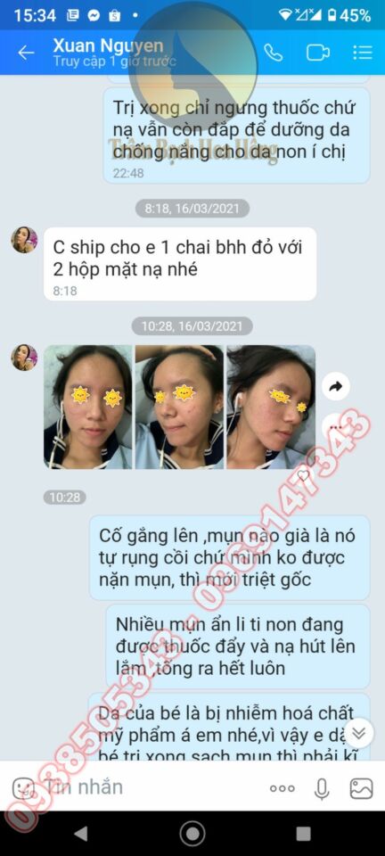 Trị mụn dậy thì 4