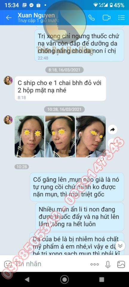 Trị mụn dậy thì 4