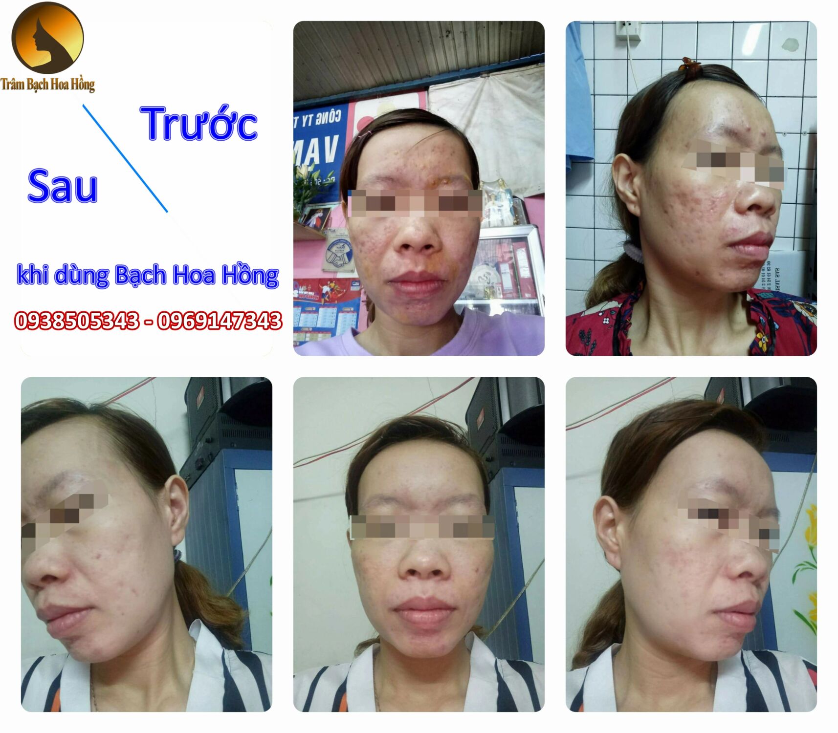 Kết quả khách hàng dùng Bạch Hoa Hồng